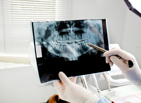 Radiografía dental panorámica sostenida con guantes mientras se señala una zona con un instrumento